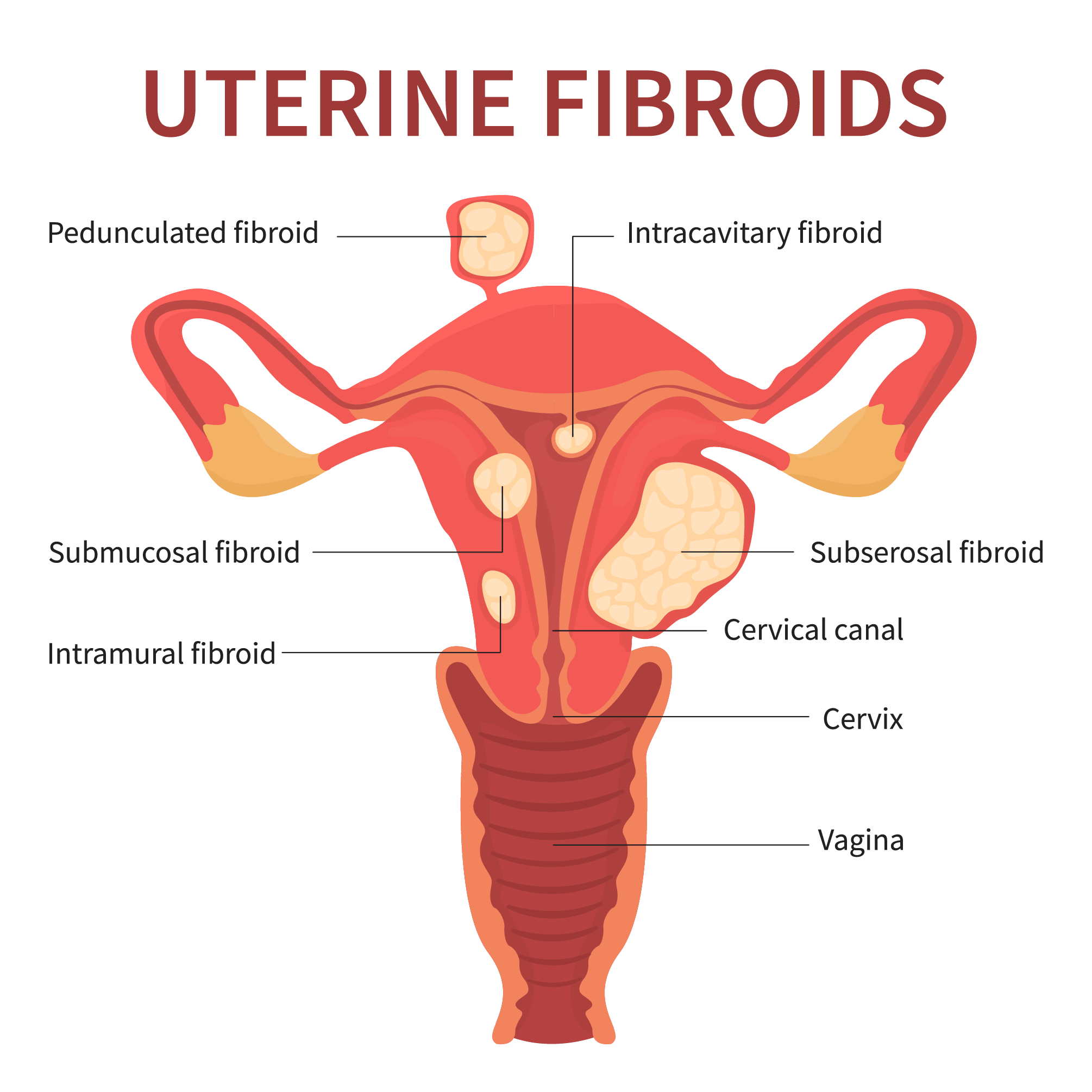 A textbook illustration showing uterine fibroids in a female reproductive system