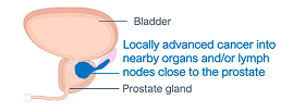 A urinary tract showing locally advanced cancer into nerby organs and/or lymph nodes close to the prostate