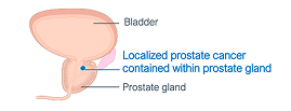 A urinary tract showing localized prostate cancer contained within the prostate gland